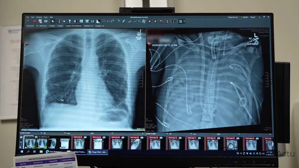 Comparaison radiographique : à droite les anciens poumons endommagés opaques, à gauche les nouveaux poumons sains.