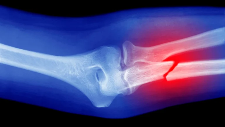 Un pistolet à colle modifié pour imprimer de l'os en 3D
