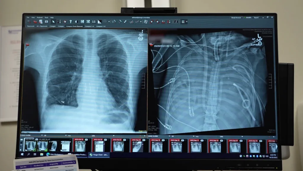 Poumon artificiel : un patient survit 48h sans poumons