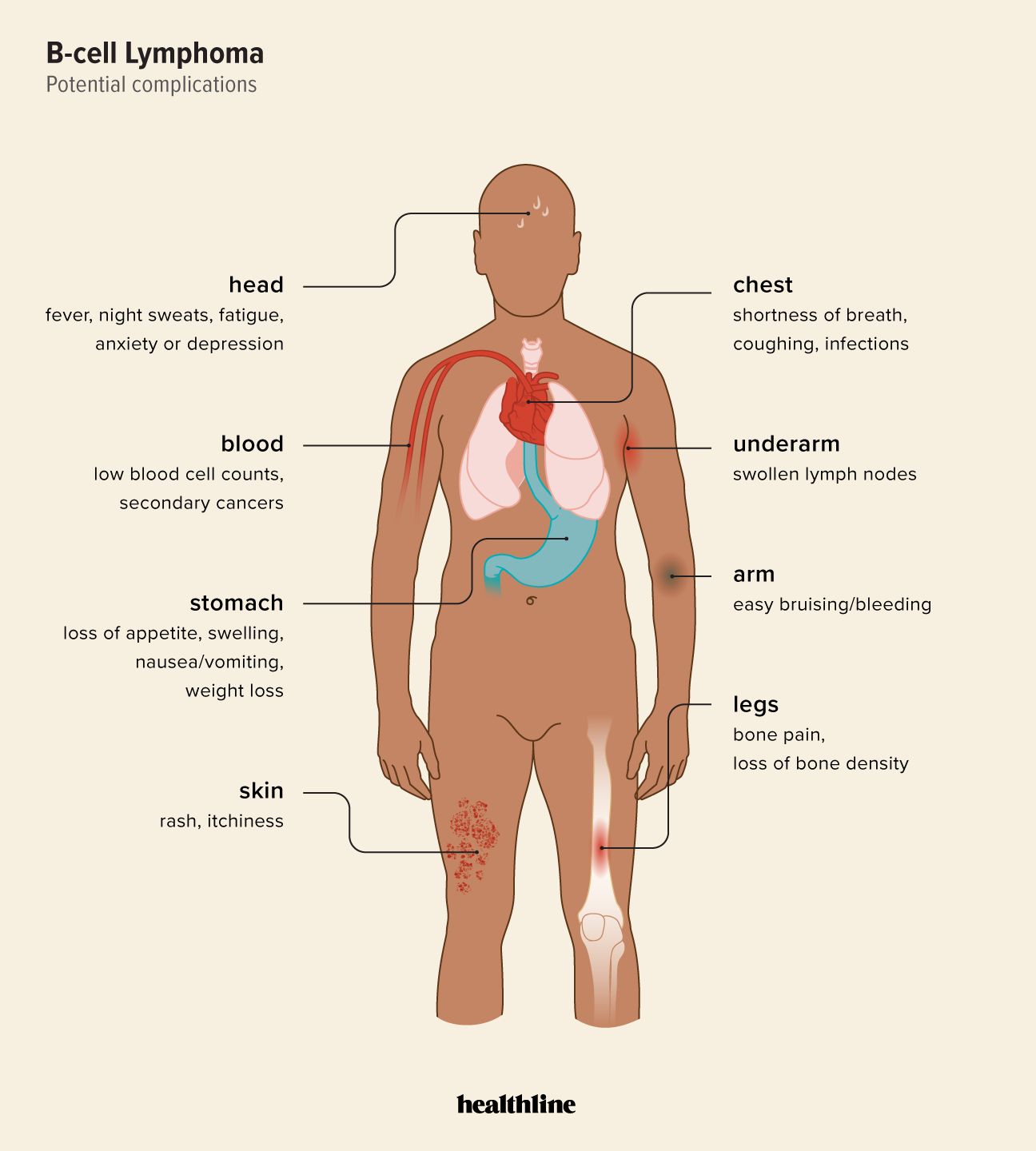 Infographie illustrant les diverses complications physiologiques associées au lymphome à cellules B et à ses traitements.