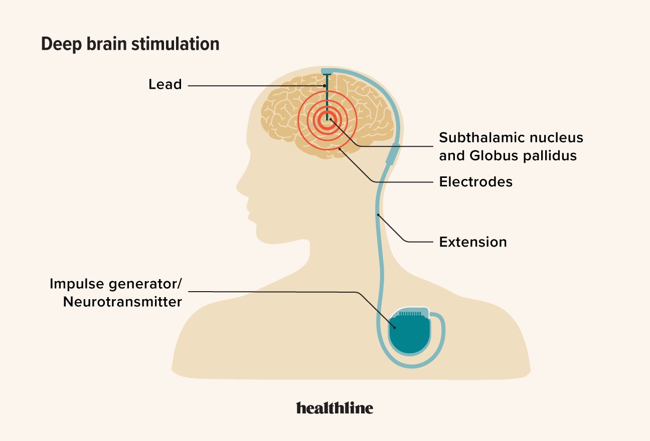 Illustration médicale d'un système de stimulation cérébrale profonde avec électrodes implantées et neurostimulateur sous-cutané