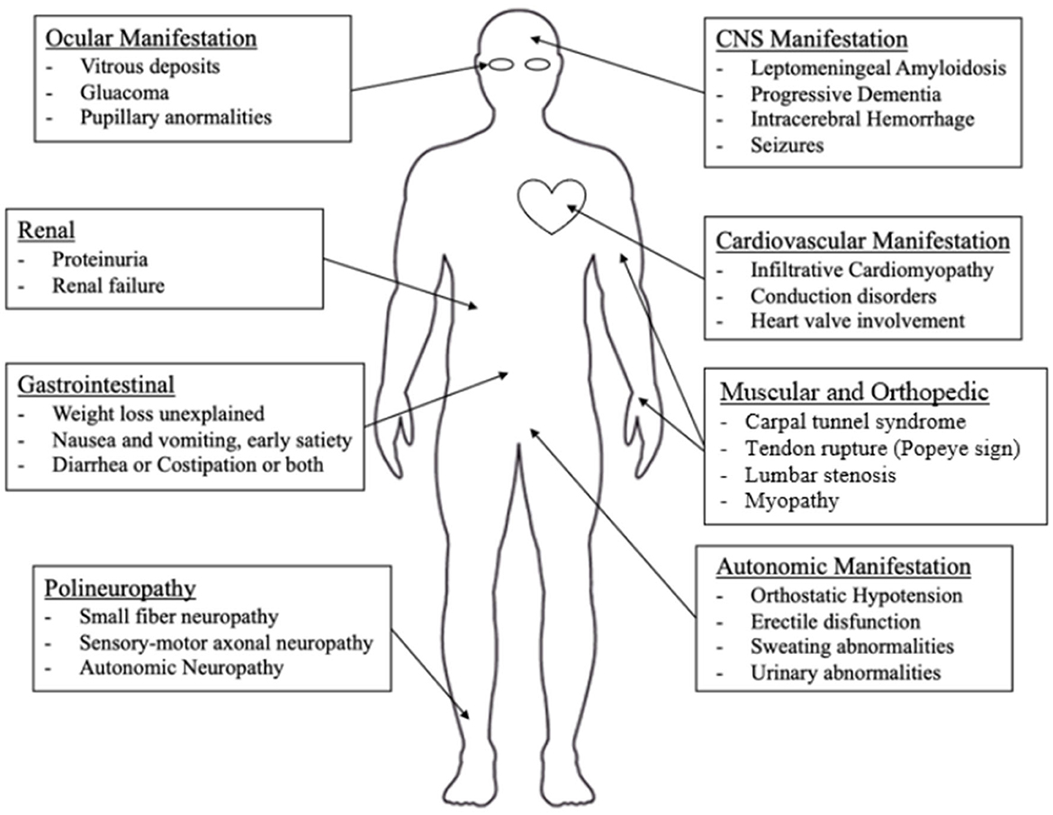 Manifestations gastro-intestinales de l'amylose hATTR