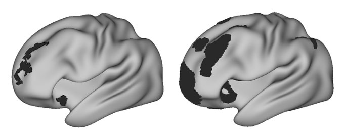 Comparaison de l'étendue du réseau de la saillance entre un cerveau sain et un cerveau dépressif