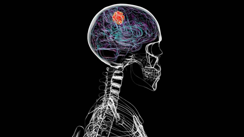 Illustration d'un glioblastome sur une radiographie de tête humaine
